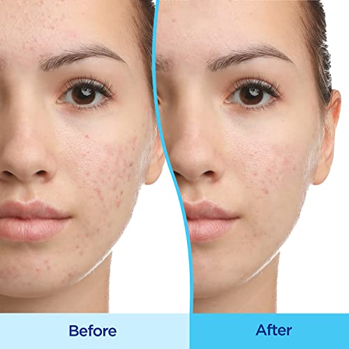 Differin Acne Treatment Gel 30 Day Supply 15g Tube