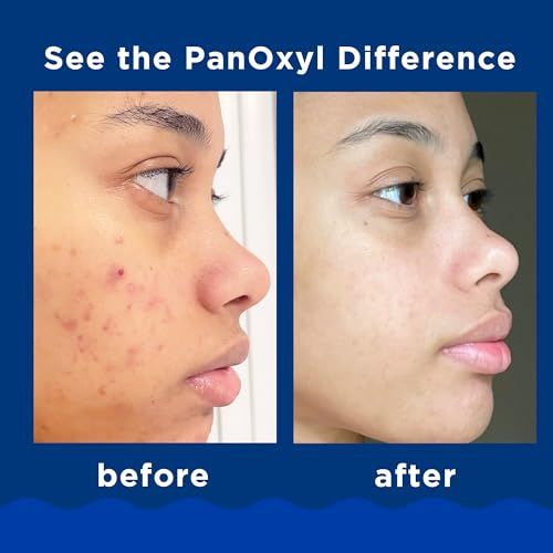 PanOxyl Acne Foaming Wash Benzoyl Peroxide 10% 5.5 Oz USA Supplements Direct  B081KL2QYJ